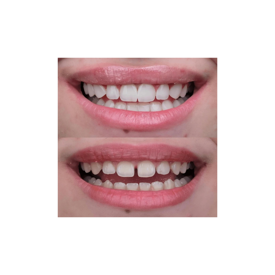 Clear orthodontic aligners